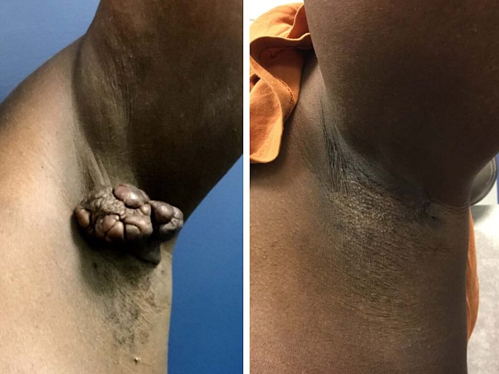 arm keloid