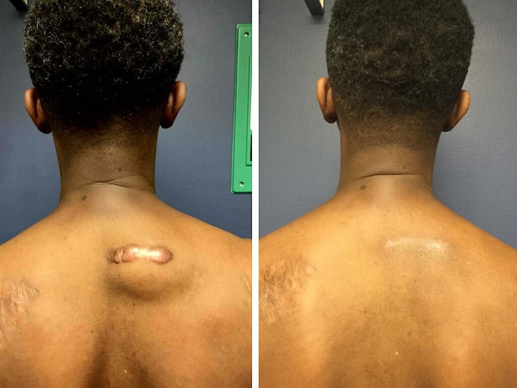 keloid on back