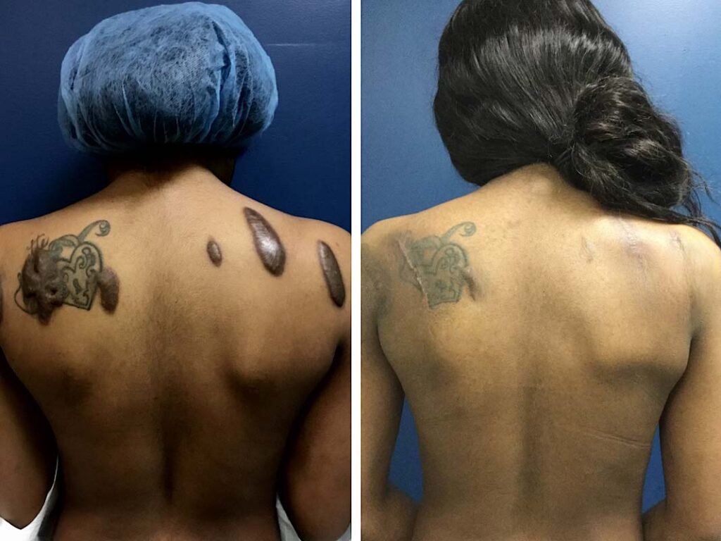 keloid back
