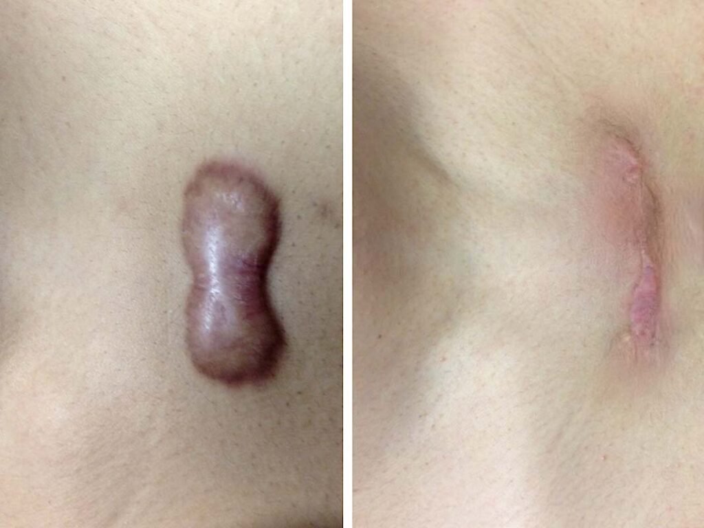 chest keloid removal