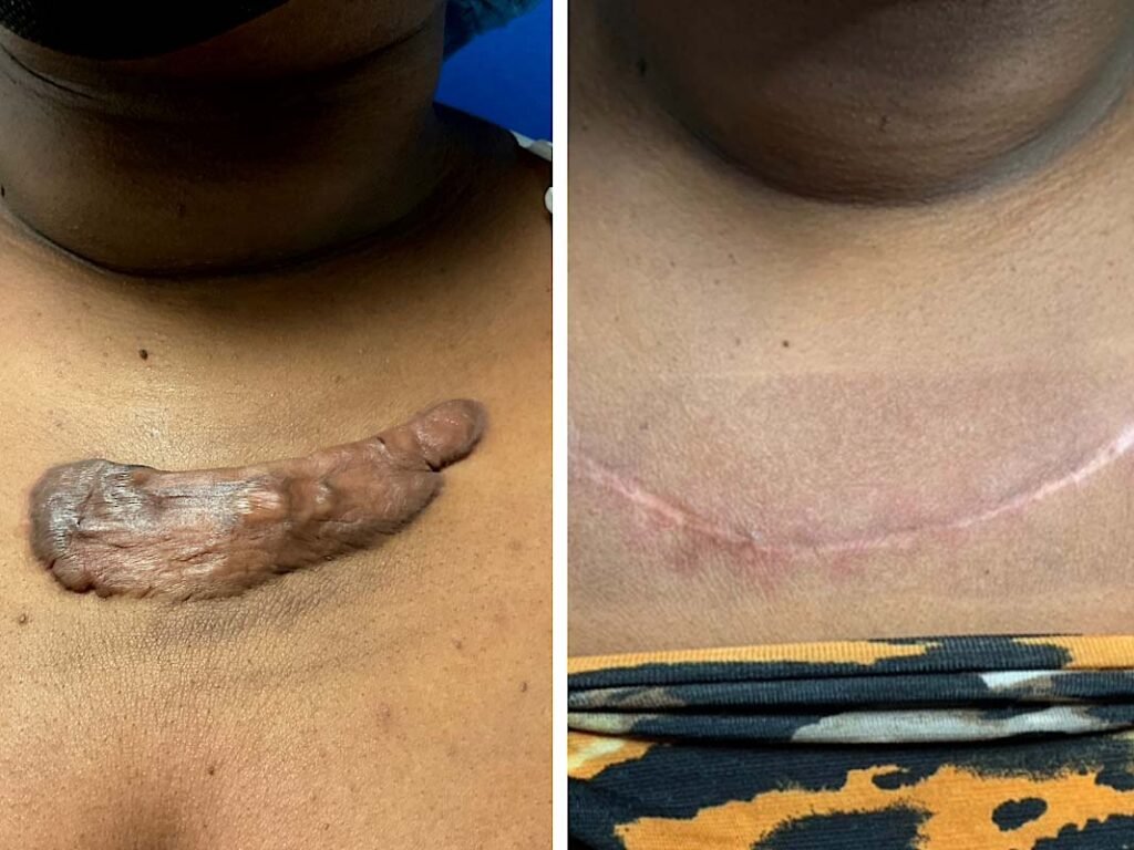 Keloid chest