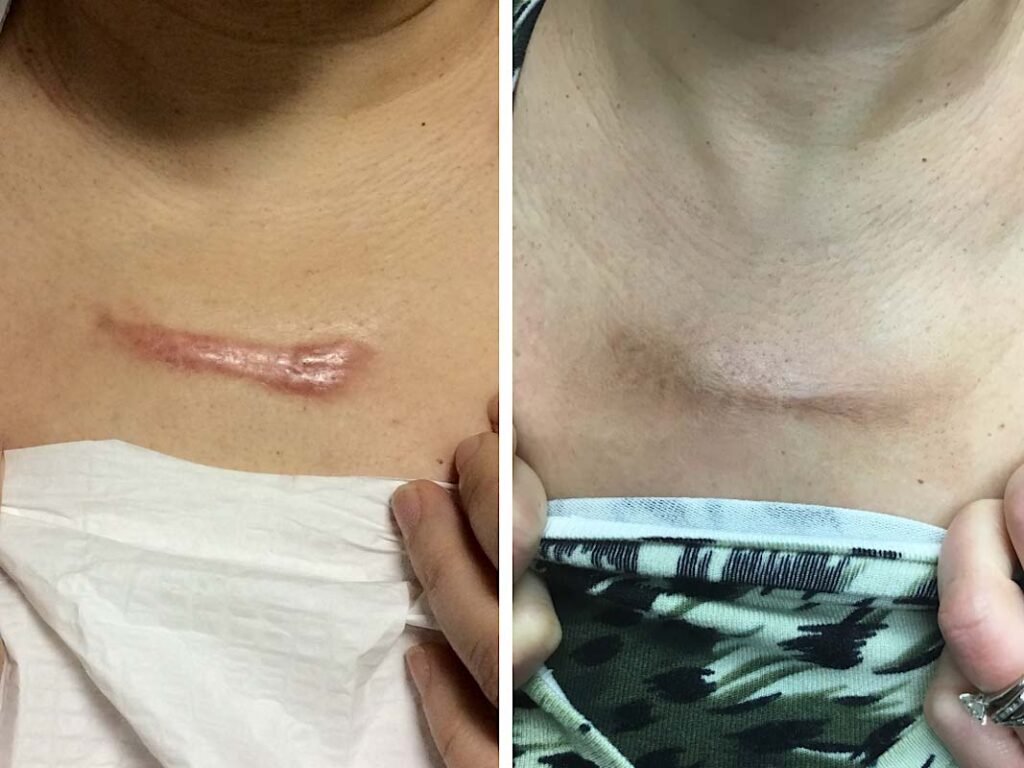 chest keloid