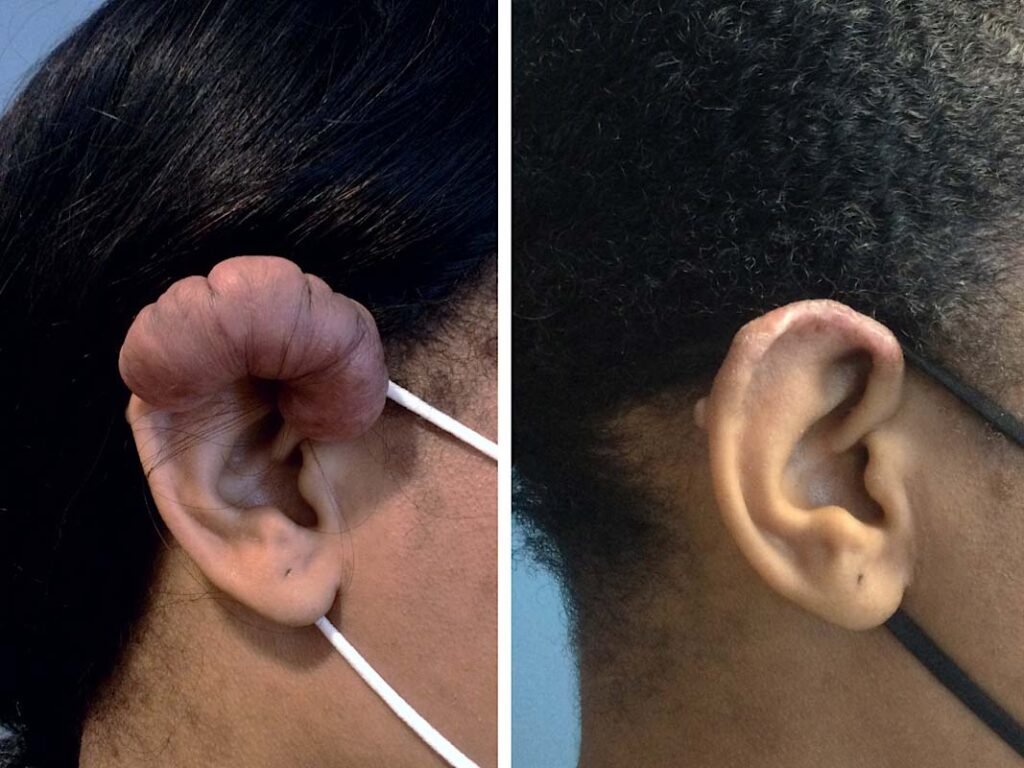 ear keloid