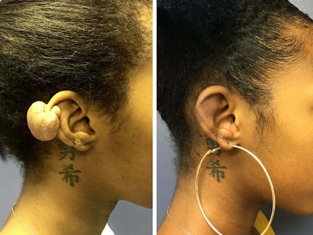 keloid removal ear