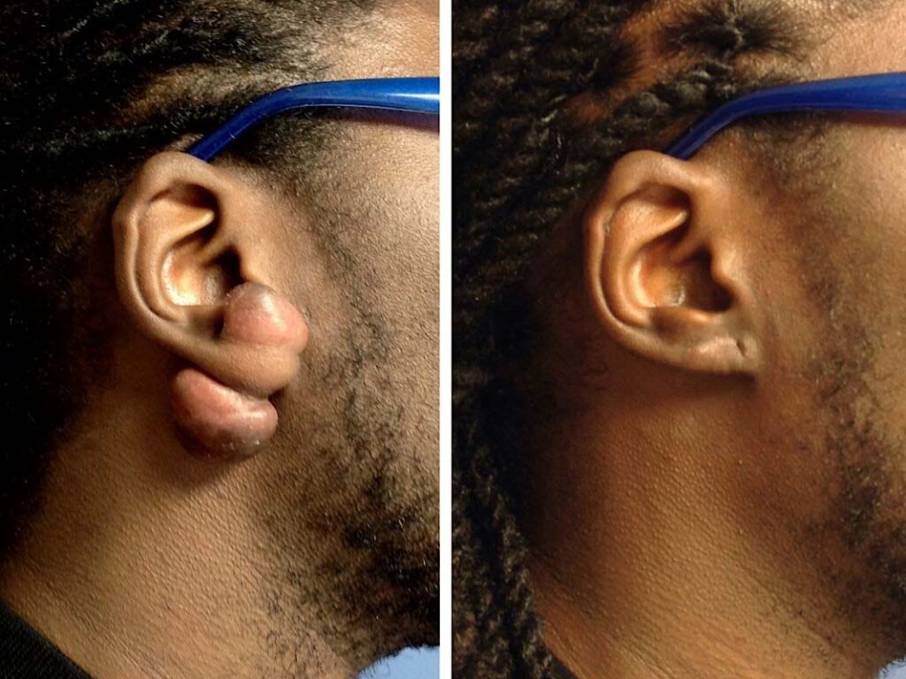 ear keloid removal at drkeloid