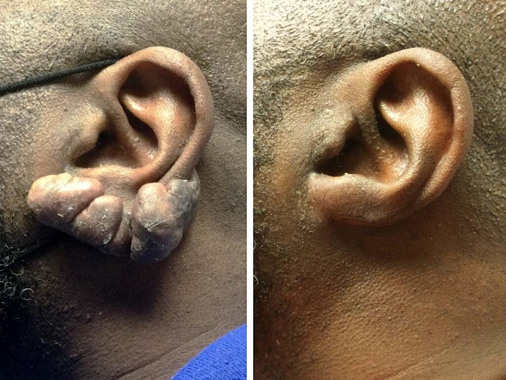 removal or ear keloid