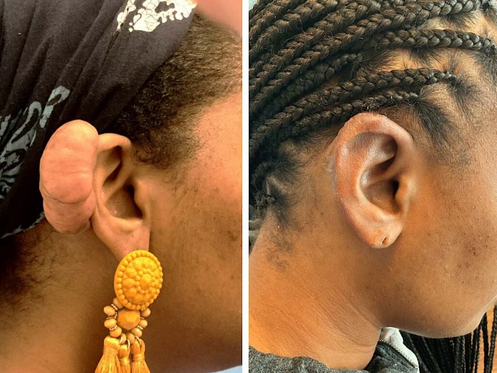 ear keloid removal