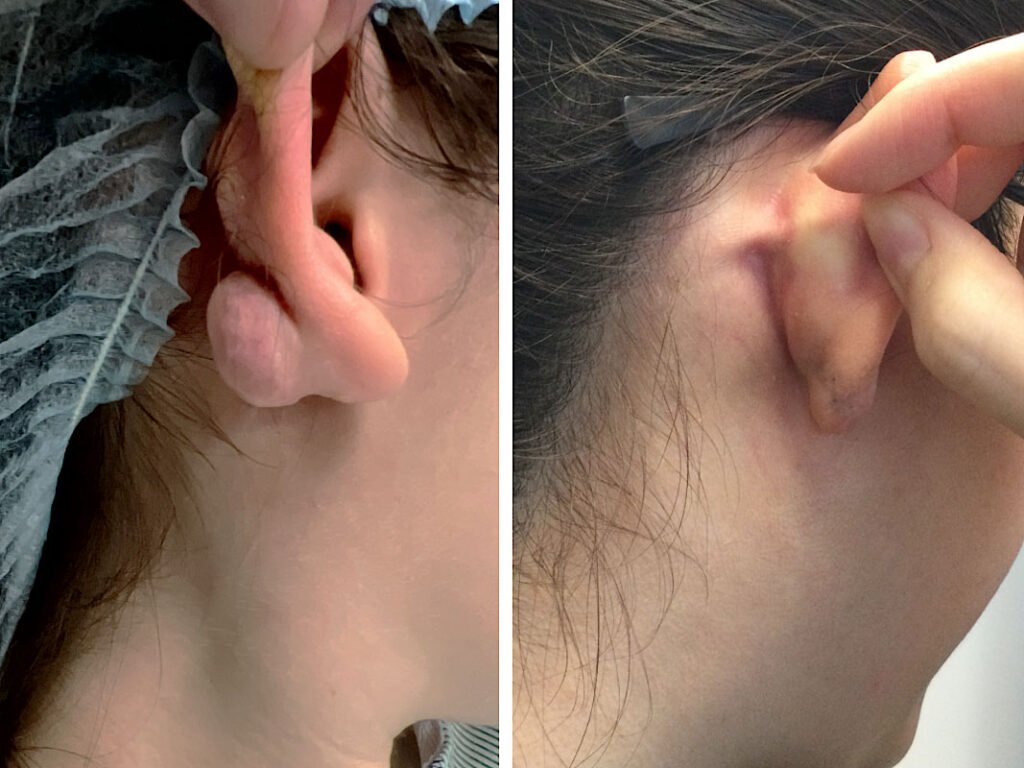 removal of keloid