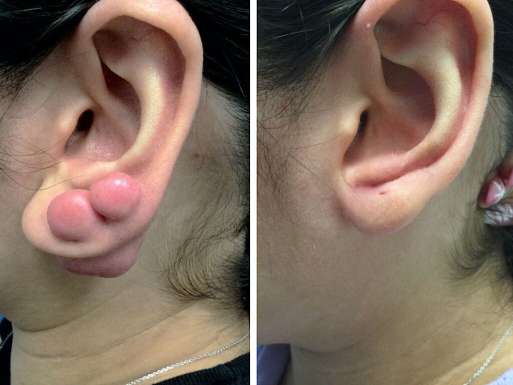 keloid removal