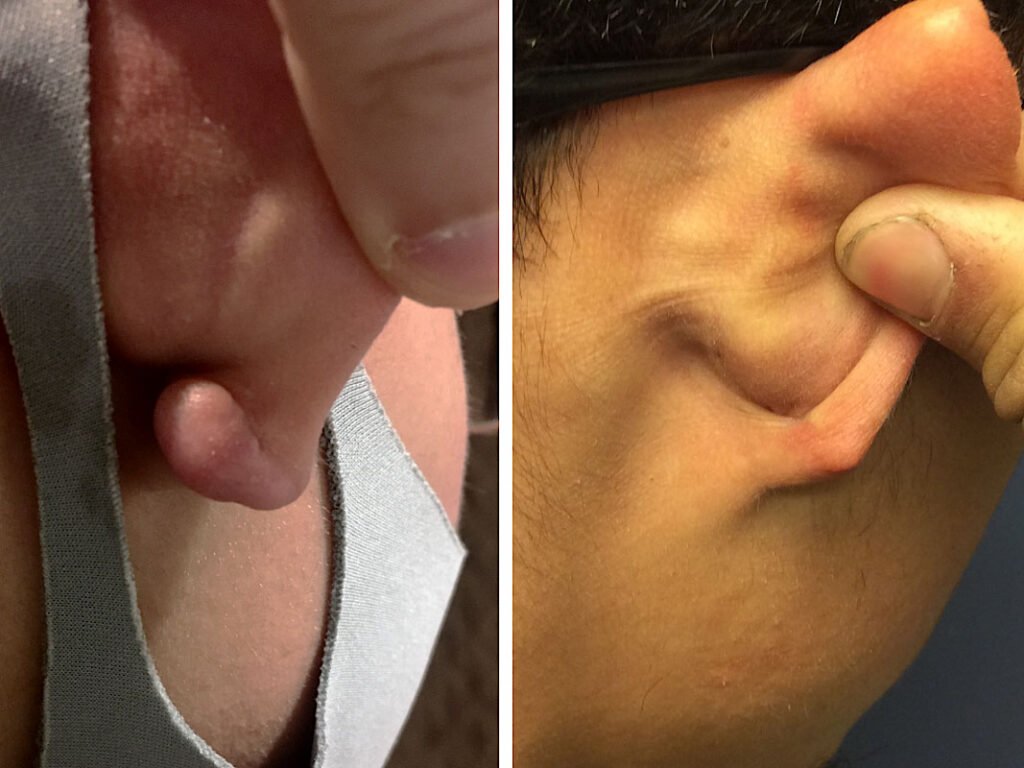 keloid ear removal