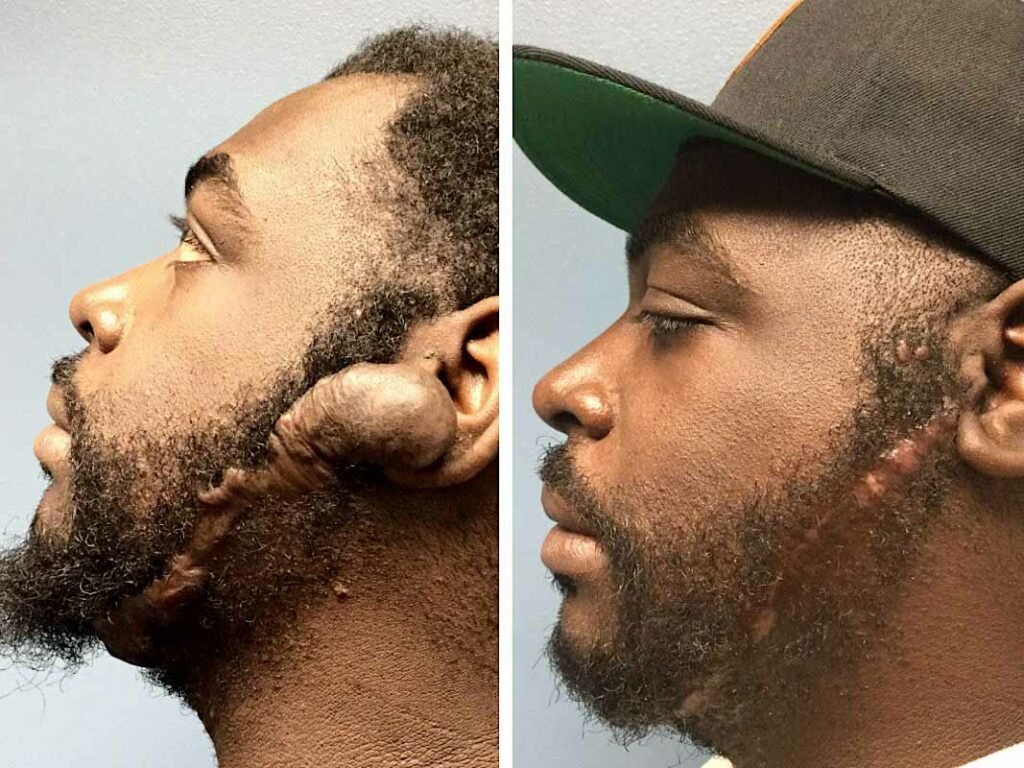 face keloid