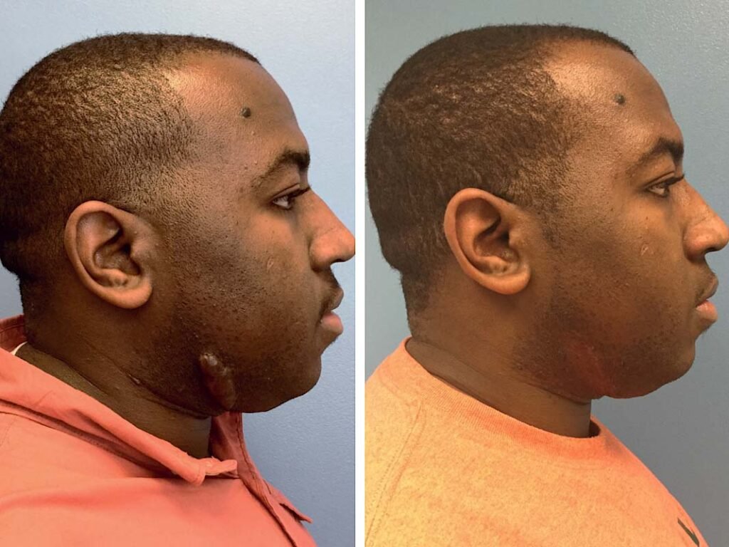keloid removal from face