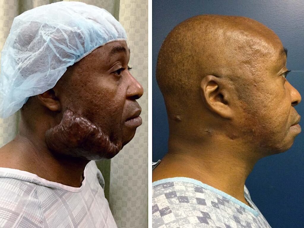 face keloid