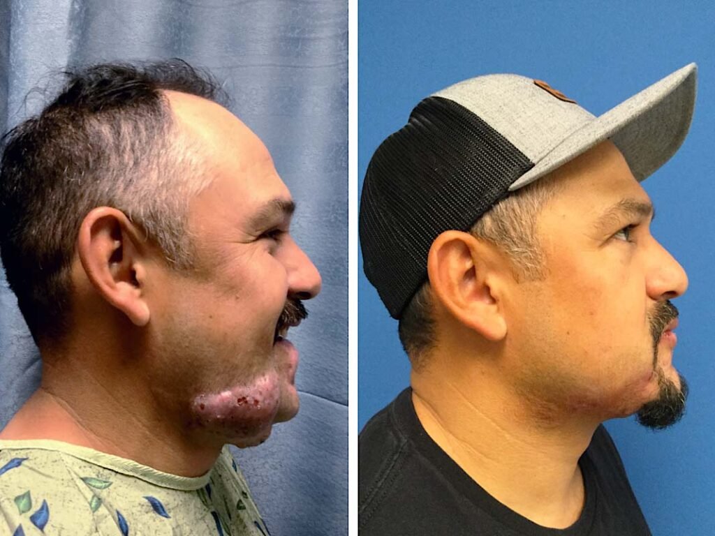 keloid removal face