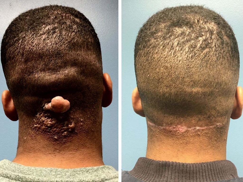 keloid face removal