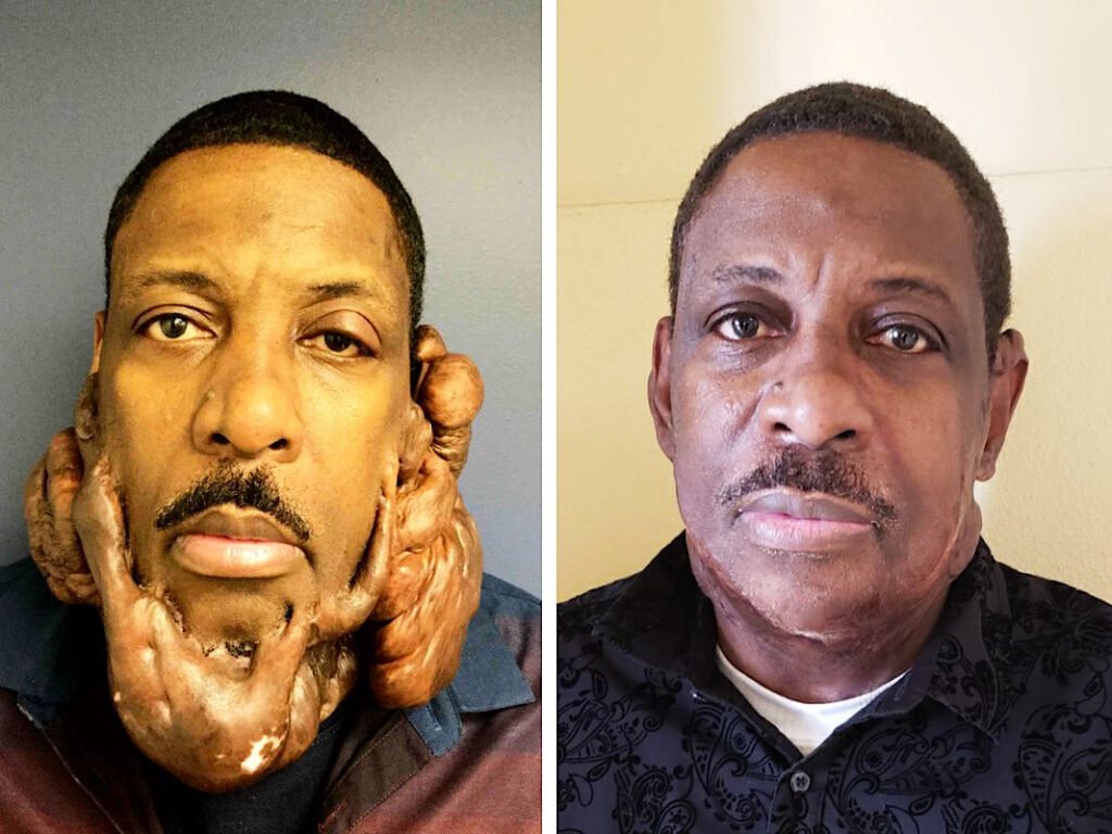 face keloid removal