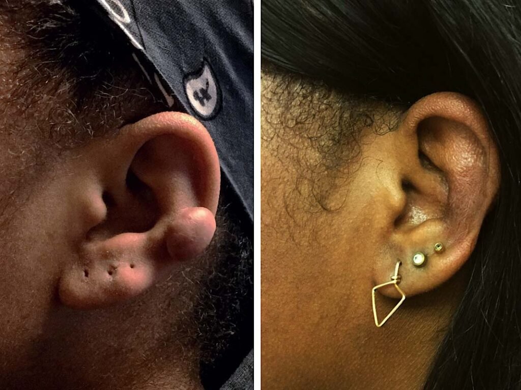keloid removal ear