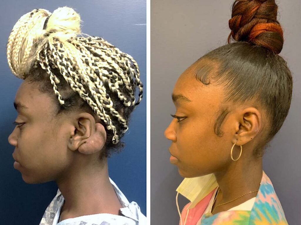 Ear surgery