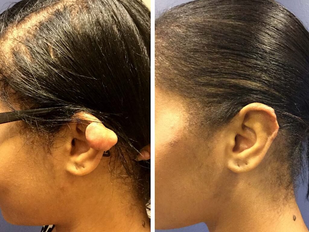 ear keloid gallery