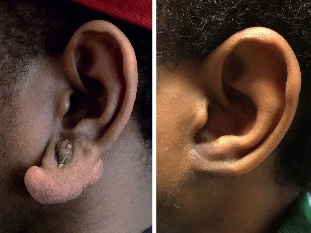 ear keloid remove