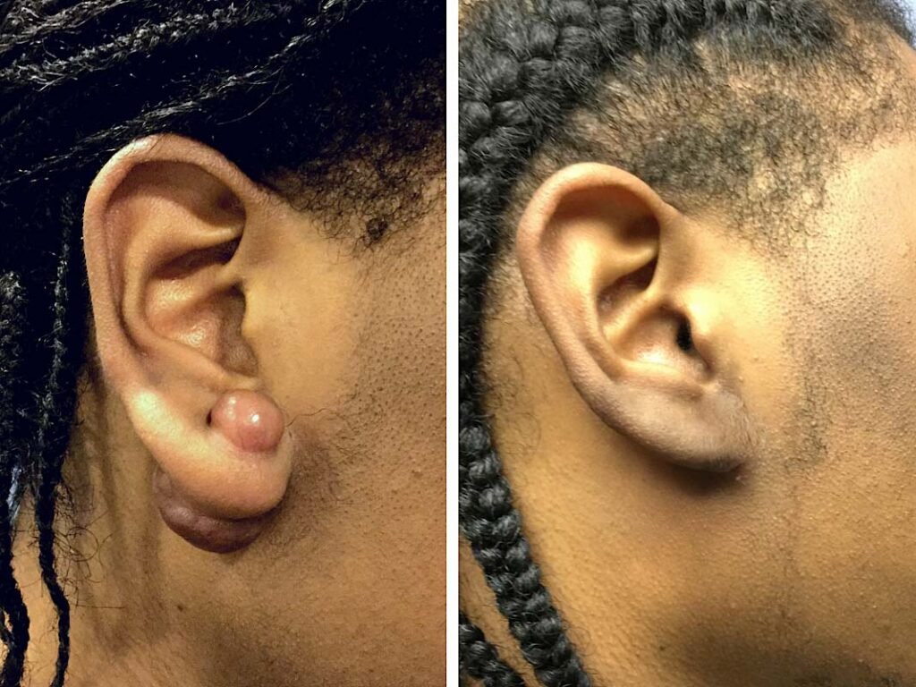 keloid remove from ear