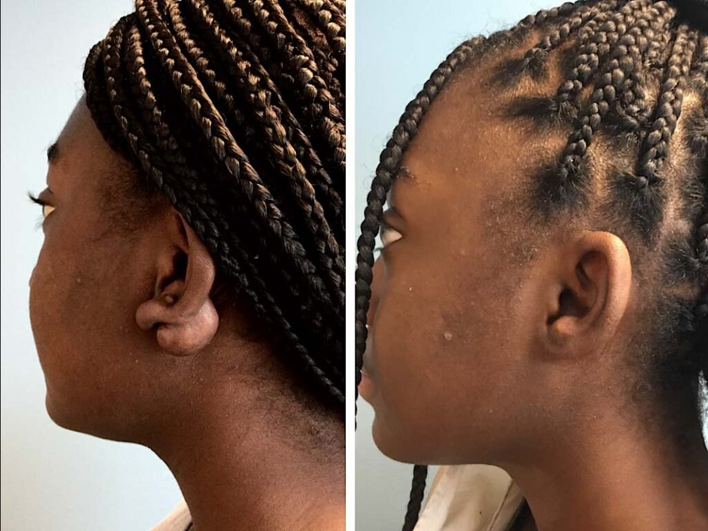 removal of ear keliod