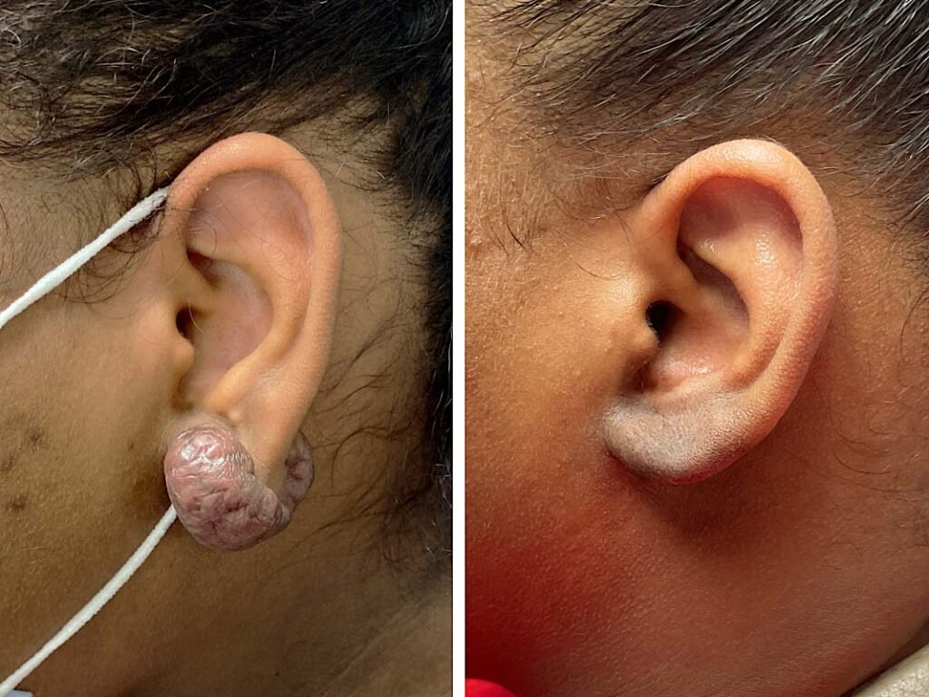 lpsadmin ear keloid