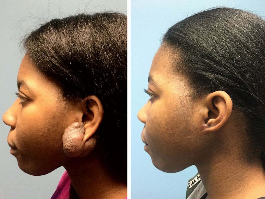keloid ear removal