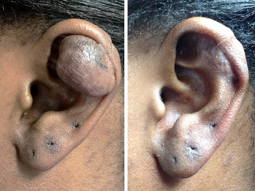keloid