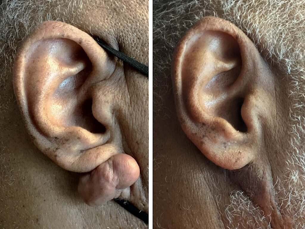 lpsadmin ear keloid