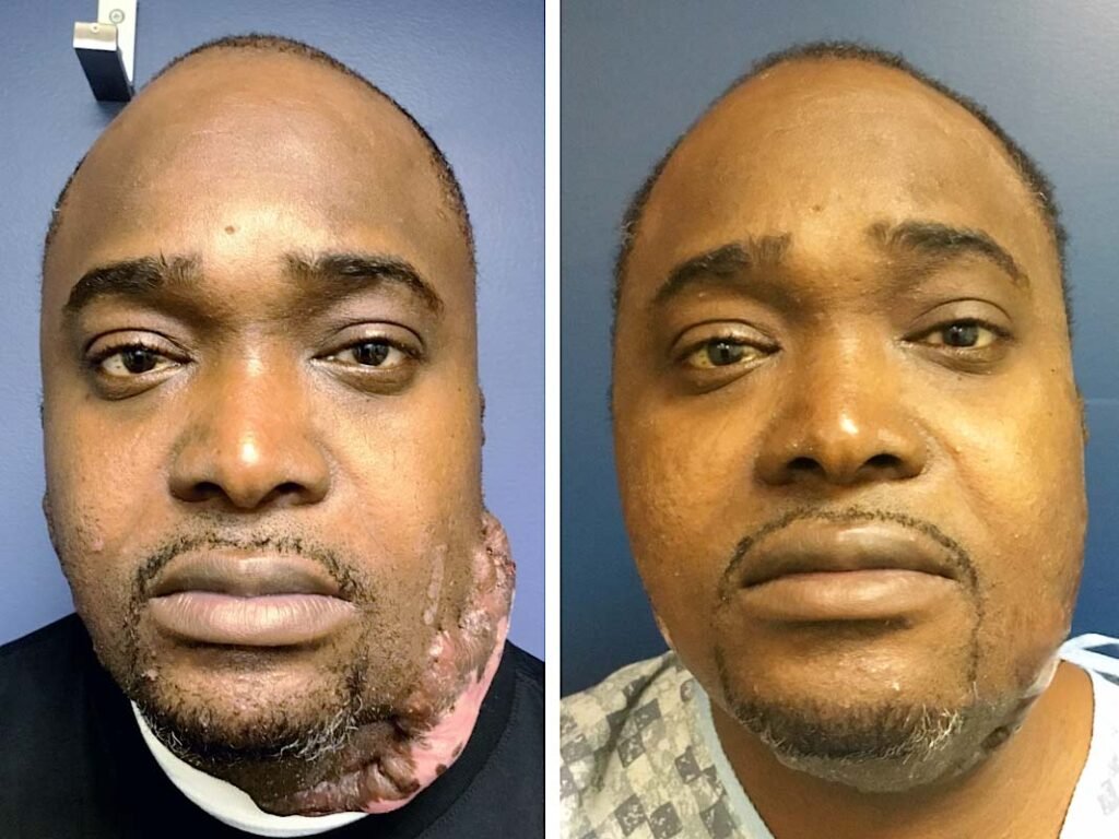 face keloid surgery