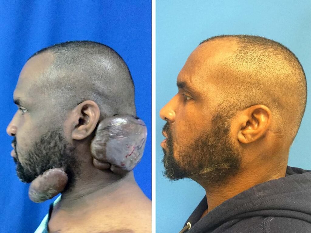 keloid scar removal
