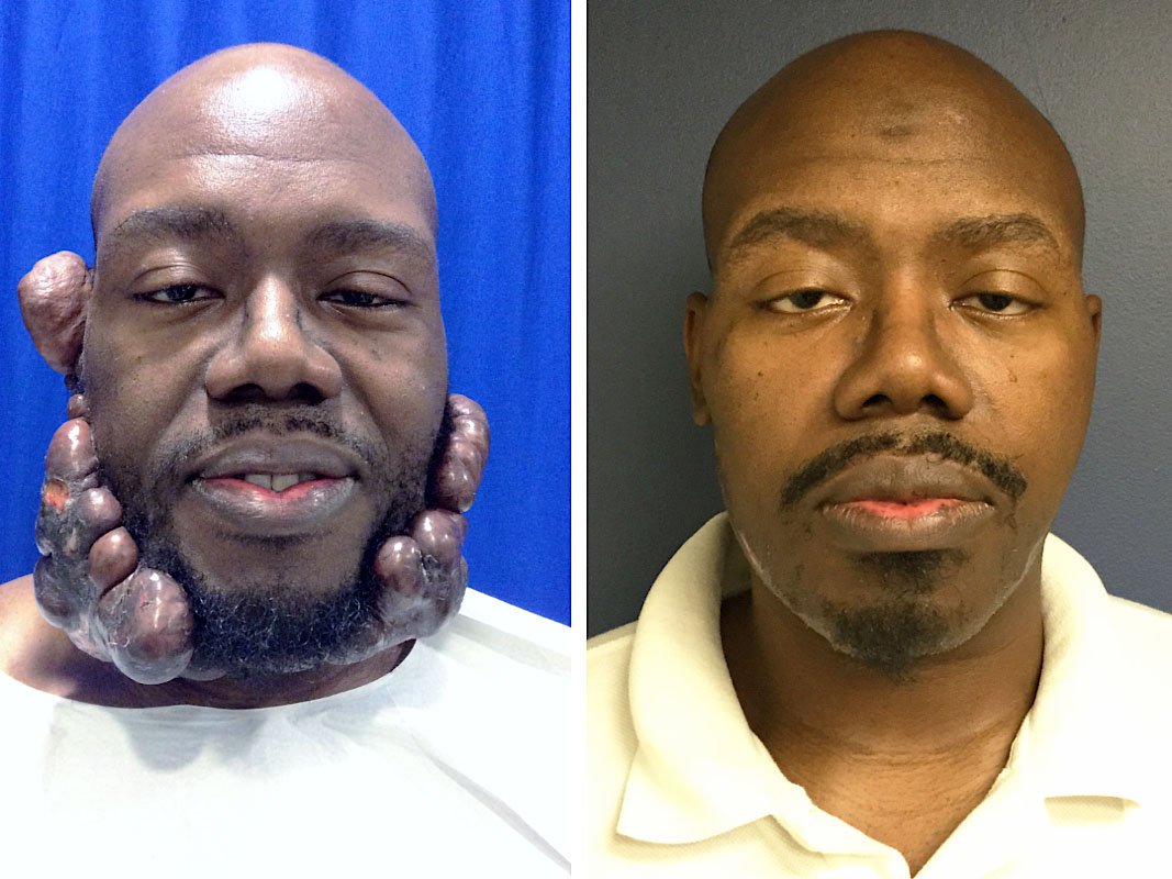 Keloid removal from face