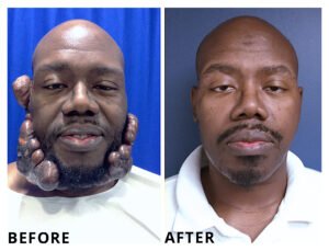 Keloid-removal-Keenan-results