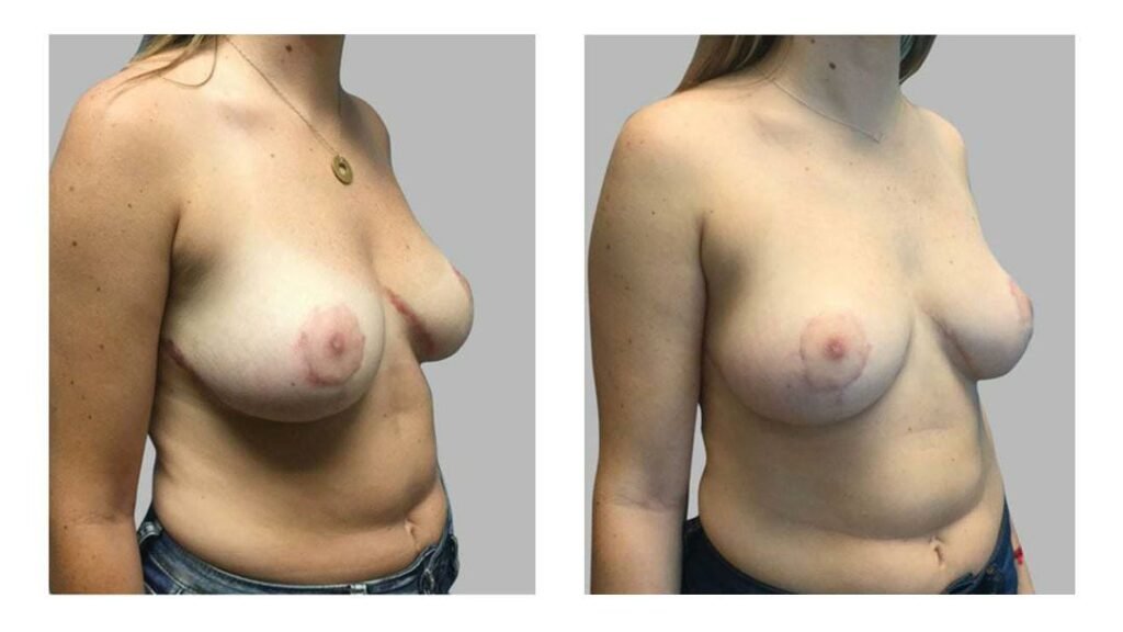 Breast reduction surgery procedure
