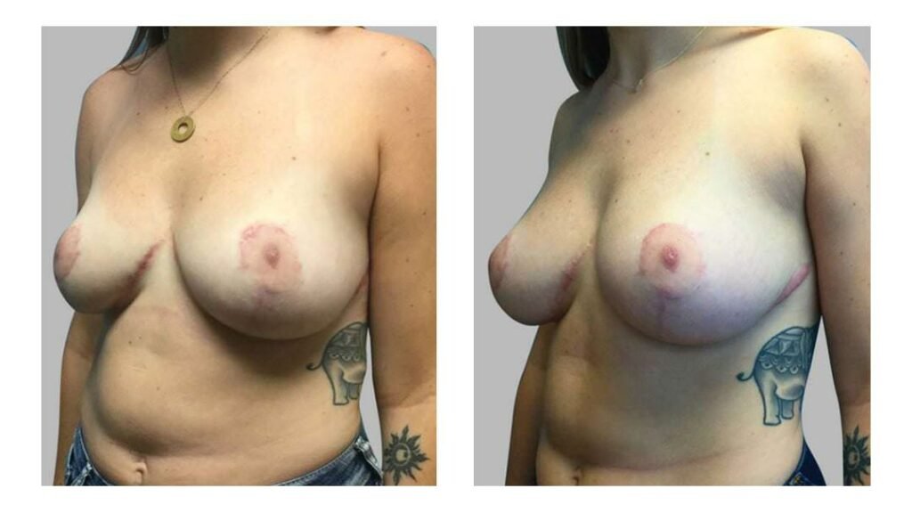Breast reduction surgery results