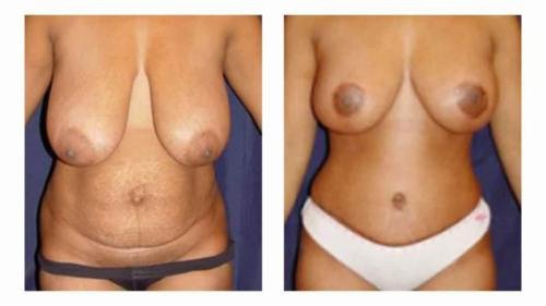 Breast reduction surgery results