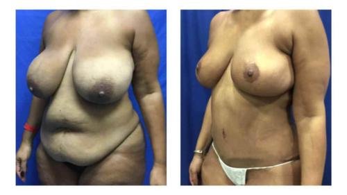 Breast reduction surgery recovery