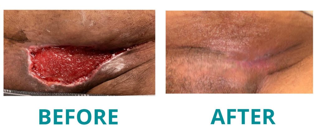 Before and after wound healing treatment