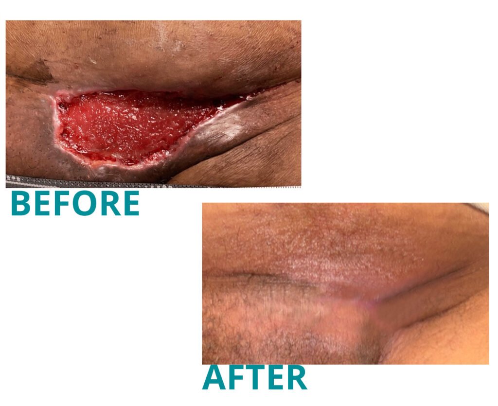 Before and after wound healing treatment